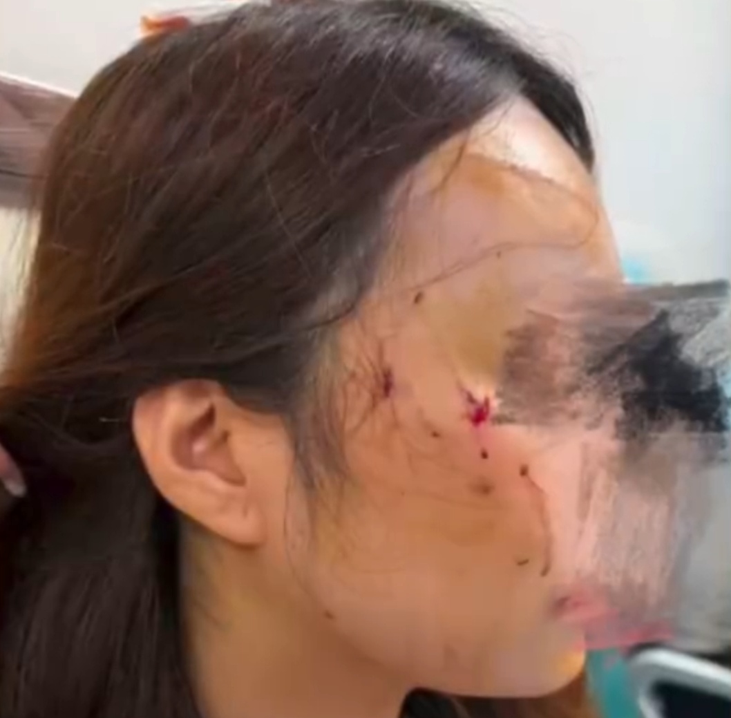 惨不忍睹！女子被自家猫攻击，颅部3级损伤，头皮撕开4厘米