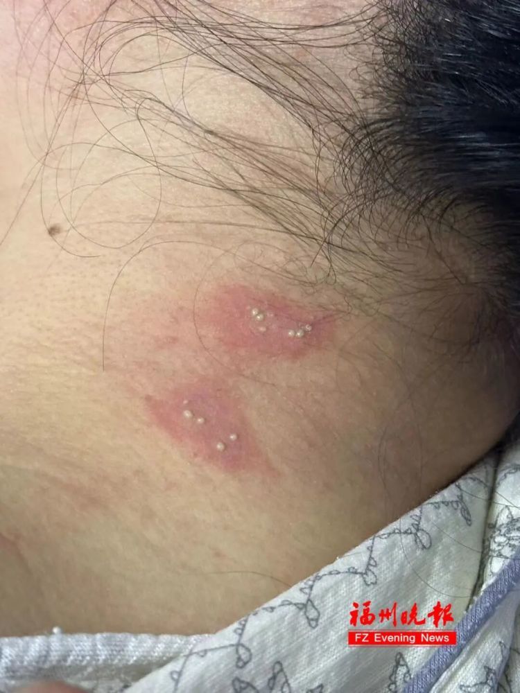 这种虫堪比硫酸!女子接触它后,视力骤降至0.08!福州医生:千万别拍 这种虫堪比硫酸!女子接触它后,视力骤降至0.08!福州医生:千万别拍