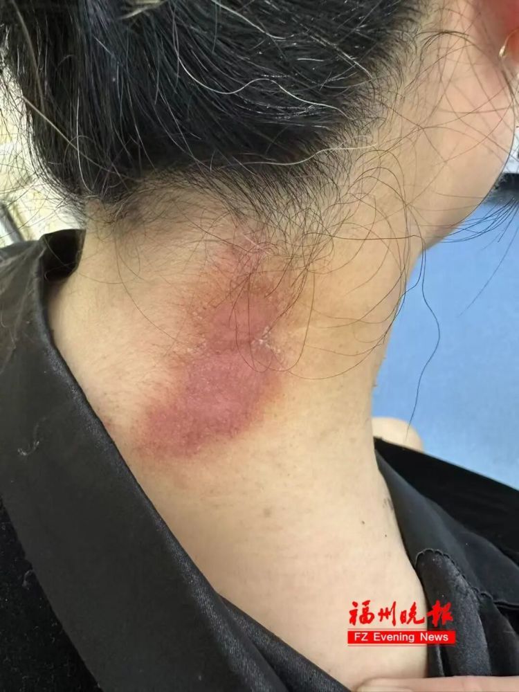 这种虫堪比硫酸!女子接触它后,视力骤降至0.08!福州医生:千万别拍 这种虫堪比硫酸!女子接触它后,视力骤降至0.08!福州医生:千万别拍