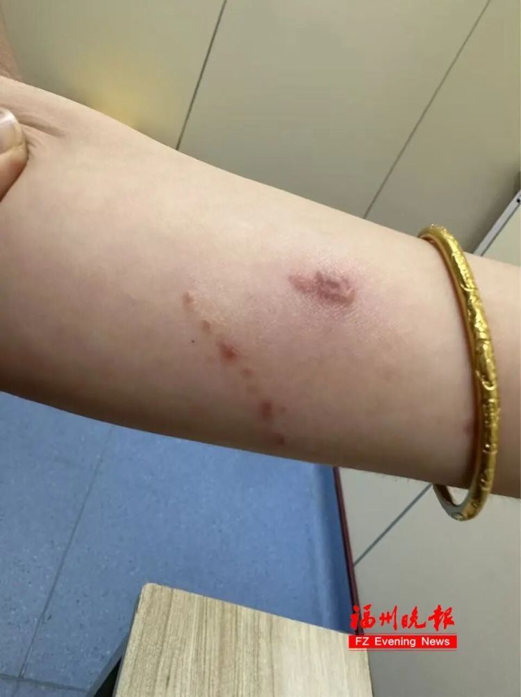 这种虫堪比硫酸!女子接触它后,视力骤降至0.08!福州医生:千万别拍 这种虫堪比硫酸!女子接触它后,视力骤降至0.08!福州医生:千万别拍
