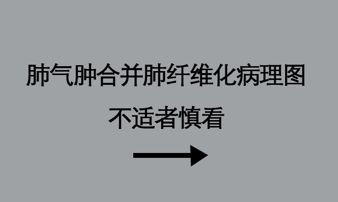 67岁，他的肺变成了“马蜂窝”