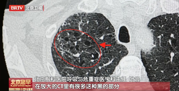 67岁，他的肺变成了“马蜂窝”
