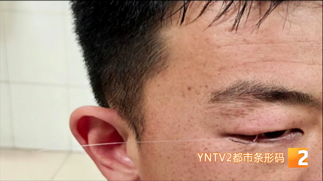 隔着屏幕都疼!夜钓甩钩失误,男子被鱼钩直接勾住眼皮,到医院后还得求助消防...... 隔着屏幕都疼!夜钓甩钩失误,男子被鱼钩直接勾住眼皮,到医院后还得求助消防......