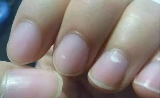 指甲能预示身体问题?要警惕这5种指甲变化,一个比一个危险 指甲能预示身体问题?要警惕这5种指甲变化,一个比一个危险
