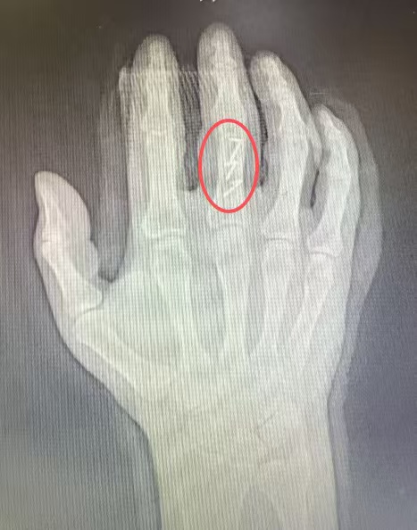 爸爸辅导作业时气得怒挥空水桶,中指“咔嗒”骨折!医生紧急提醒 爸爸辅导作业时气得怒挥空水桶,中指“咔嗒”骨折!医生紧急提醒