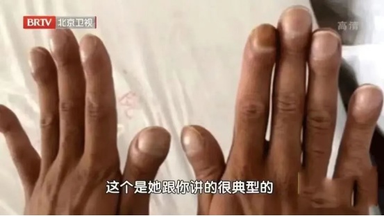 指甲能预示身体问题?要警惕这5种指甲变化,一个比一个危险 指甲能预示身体问题?要警惕这5种指甲变化,一个比一个危险