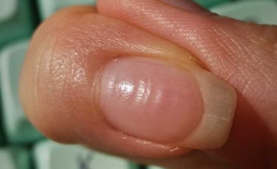 指甲能预示身体问题?要警惕这5种指甲变化,一个比一个危险 指甲能预示身体问题?要警惕这5种指甲变化,一个比一个危险