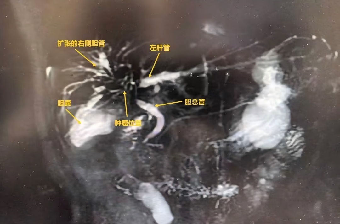 长期熬夜加班,天天吃外卖,深圳一女子确诊“癌王” 长期熬夜加班,天天吃外卖,深圳一女子确诊“癌王”