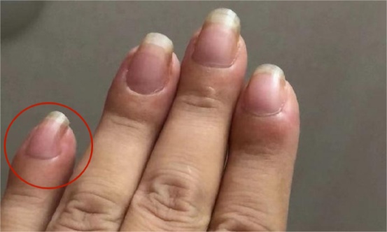指甲能预示身体问题?要警惕这5种指甲变化,一个比一个危险 指甲能预示身体问题?要警惕这5种指甲变化,一个比一个危险