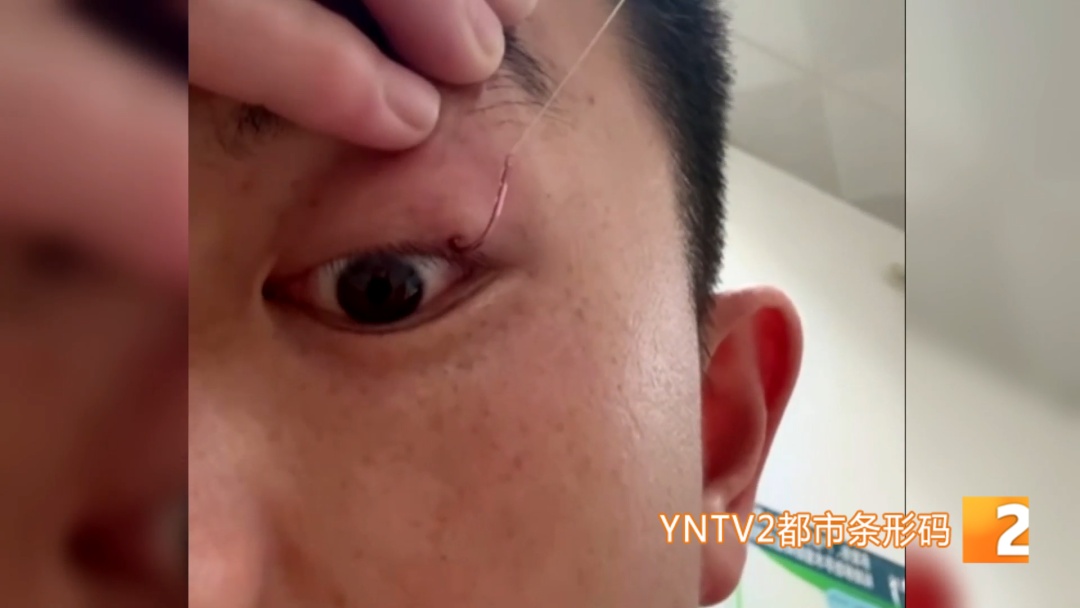 隔着屏幕都疼!夜钓甩钩失误,男子被鱼钩直接勾住眼皮,到医院后还得求助消防...... 隔着屏幕都疼!夜钓甩钩失误,男子被鱼钩直接勾住眼皮,到医院后还得求助消防......