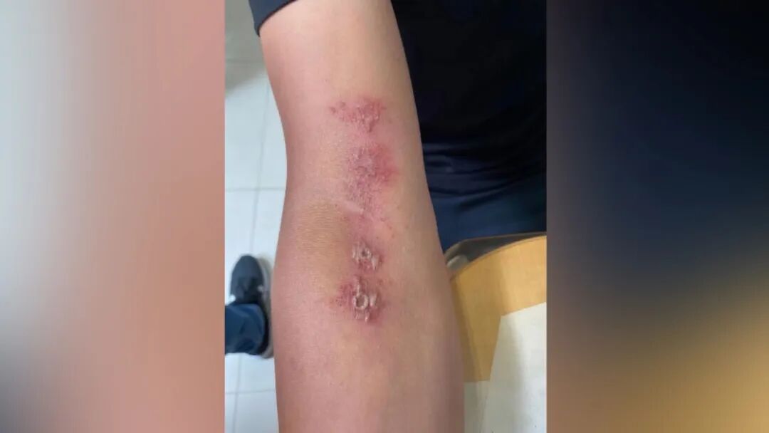 汪苏泷疑似手捏隐翅虫,网友隔空喊“住手”!医生提醒:毒液堪比硫酸,严重会“毁容” 汪苏泷疑似手捏隐翅虫,网友隔空喊“住手”!医生提醒:毒液堪比硫酸,严重会“毁容”