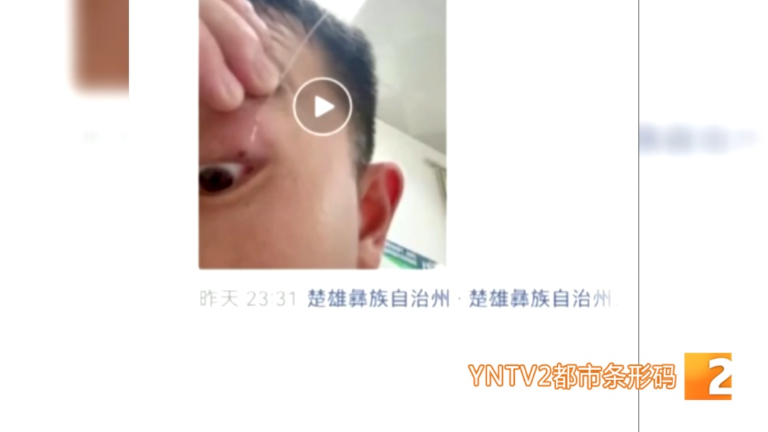 隔着屏幕都疼!夜钓甩钩失误,男子被鱼钩直接勾住眼皮,到医院后还得求助消防...... 隔着屏幕都疼!夜钓甩钩失误,男子被鱼钩直接勾住眼皮,到医院后还得求助消防......