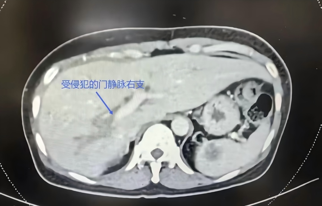 女子确诊“癌王”，全身发黄！整晚痒得睡不着，“恨不得拿钢丝球搓自己”