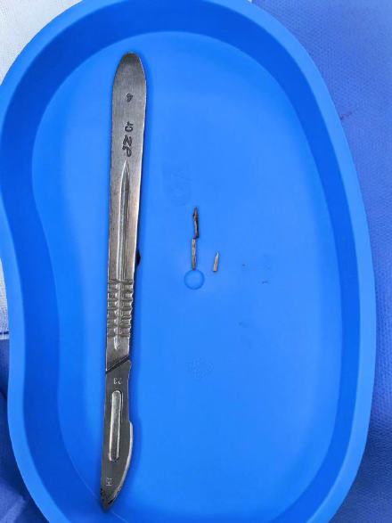 男子误吞鱼刺6年腹壁化脓才发现