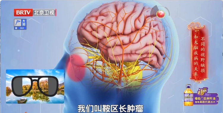 脑梗来临，眼睛先知？出现这3种改变，是脑梗的“最后通牒”！千万别拖