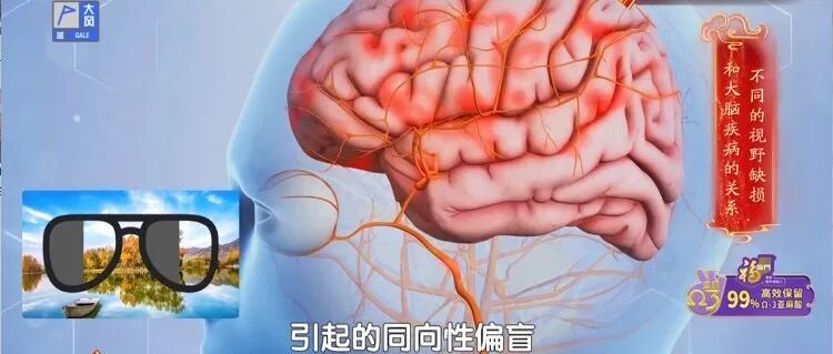 脑梗来临，眼睛先知？出现这3种改变，是脑梗的“最后通牒”！千万别拖