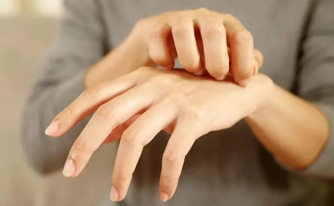 女子自卑到不敢伸手，眼下正是高发期！年年复发，又热又痒…医生紧急提醒