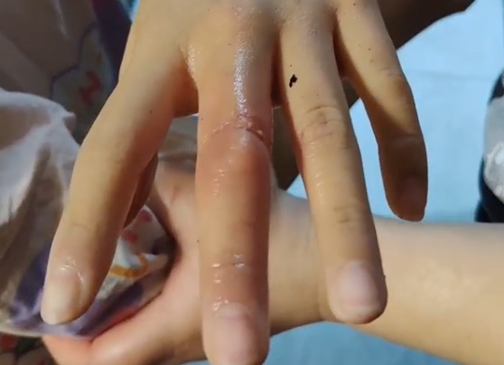 家里这个地方利如刀片！别让这条红痕出现在你家娃身上