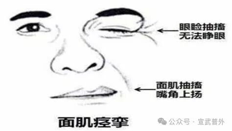 眼皮跳动，是福是祸？