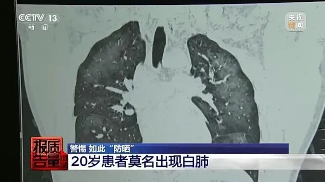 5岁男孩突然双肺大面积变白,竟与妈妈用的这东西有关!医生紧急提醒:用错了很危险 5岁男孩突然双肺大面积变白,竟与妈妈用的这东西有关!医生紧急提醒:用错了很危险