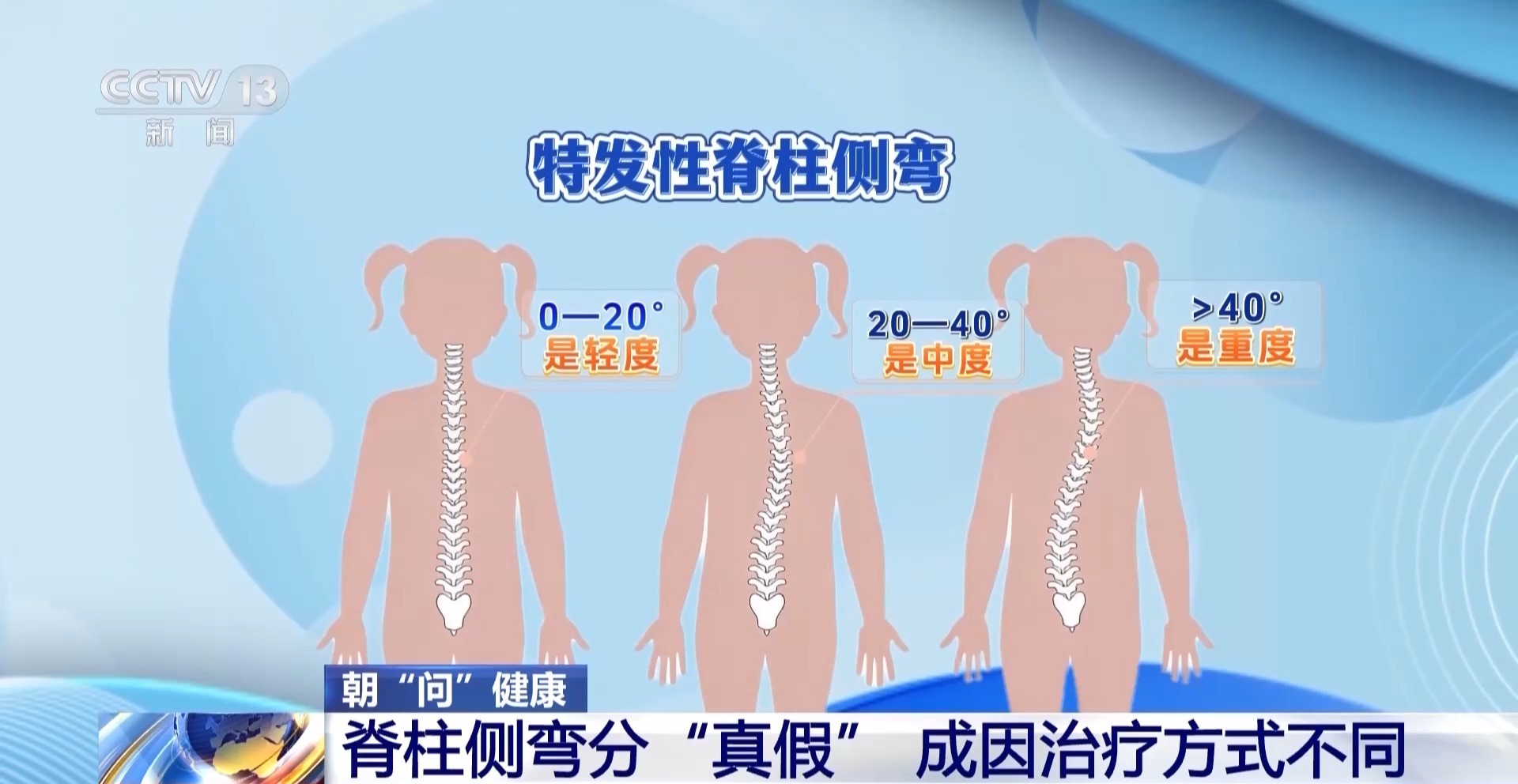 孩子高低肩、总喊腰酸背痛?这些可能是脊柱侧弯的信号 孩子高低肩、总喊腰酸背痛?这些可能是脊柱侧弯的信号