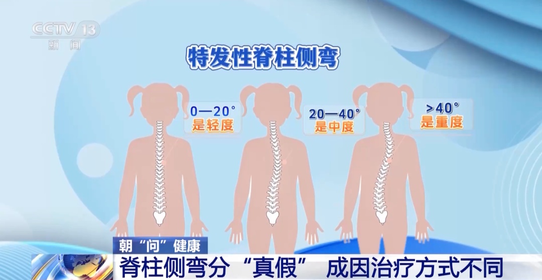 孩子高低肩、总喊腰酸背痛?可能是脊柱侧弯(附自测方法) 孩子高低肩、总喊腰酸背痛?可能是脊柱侧弯(附自测方法)