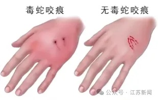 男子田间干活被毒蛇咬伤，几个自救动作获医生点赞！近期蛇咬伤多发，做对急救能保命