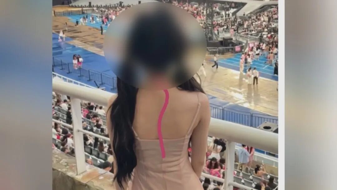 “看演唱会发现自己脊柱侧弯”!医生提醒:瘦的女生高发 “看演唱会发现自己脊柱侧弯”!医生提醒:瘦的女生高发