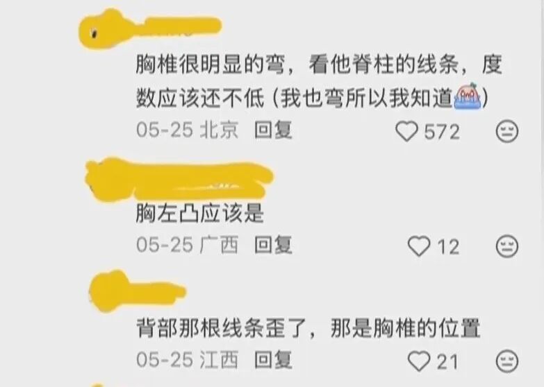 “看演唱会发现自己脊柱侧弯”!医生提醒:瘦的女生高发 “看演唱会发现自己脊柱侧弯”!医生提醒:瘦的女生高发