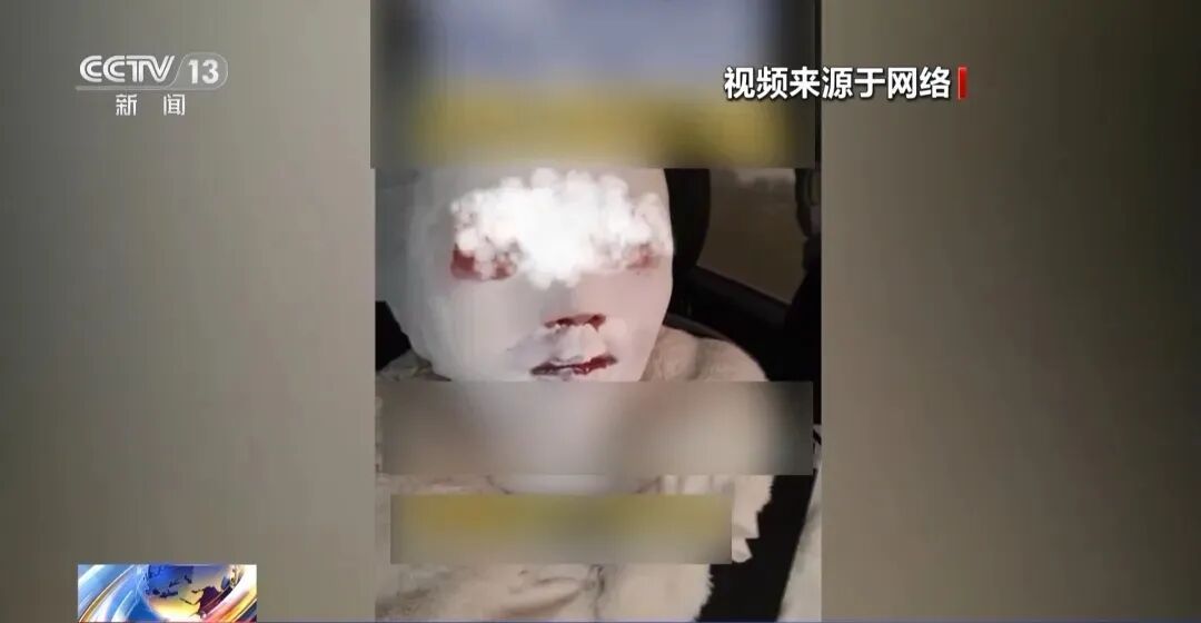 突然炸了!锅盖迎面飞来,女子颅脑重伤被送进EICU!这种锅用不对后果很严重 突然炸了!锅盖迎面飞来,女子颅脑重伤被送进EICU!这种锅用不对后果很严重