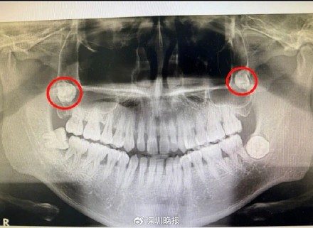 可怕!深圳小伙鼻塞流涕5年,医生竟从他的“鼻窦”里拔出一颗智齿...... 可怕!深圳小伙鼻塞流涕5年,医生竟从他的“鼻窦”里拔出一颗智齿......