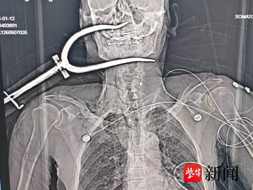 1米长铁叉意外刺入颈部!82岁老人在医院与死神擦肩而过 1米长铁叉意外刺入颈部!82岁老人在医院与死神擦肩而过