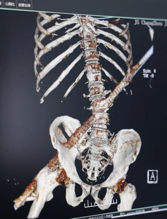 常州一男子不慎坠落,被58cm钢筋贯穿腰腹!5小时生死营救挽回生命 常州一男子不慎坠落,被58cm钢筋贯穿腰腹!5小时生死营救挽回生命