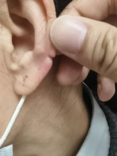 穿衣服时一扯,竟把耳朵扯裂了!医生紧急提醒:这个位置很脆弱 穿衣服时一扯,竟把耳朵扯裂了!医生紧急提醒:这个位置很脆弱