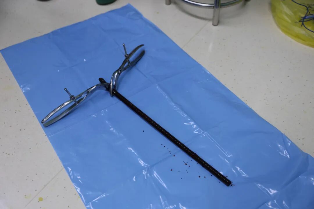 常州一男子不慎坠落,被58cm钢筋贯穿腰腹!5小时生死营救挽回生命 常州一男子不慎坠落,被58cm钢筋贯穿腰腹!5小时生死营救挽回生命