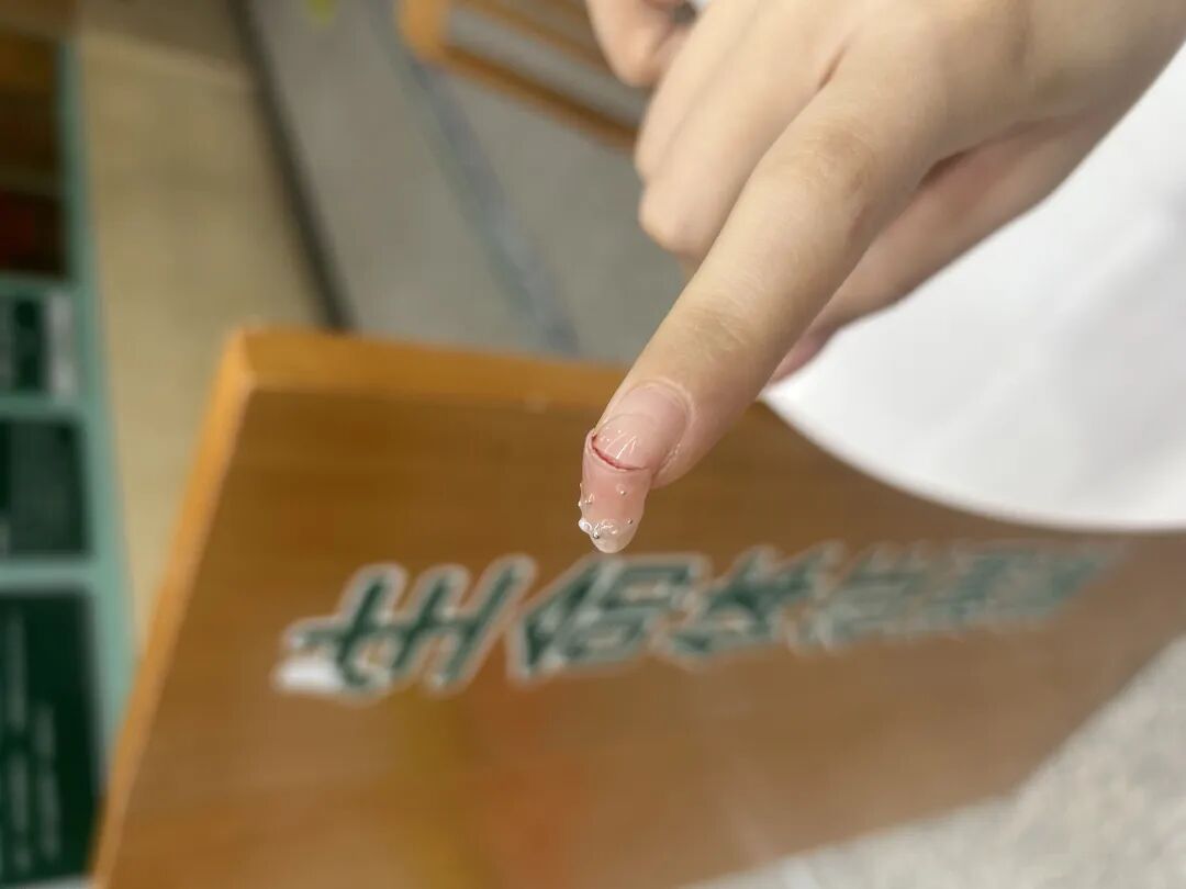 钻心的痛!女子食指甲床撕裂连夜急诊,只因频繁美甲打磨,指甲薄得透光 钻心的痛!女子食指甲床撕裂连夜急诊,只因频繁美甲打磨,指甲薄得透光