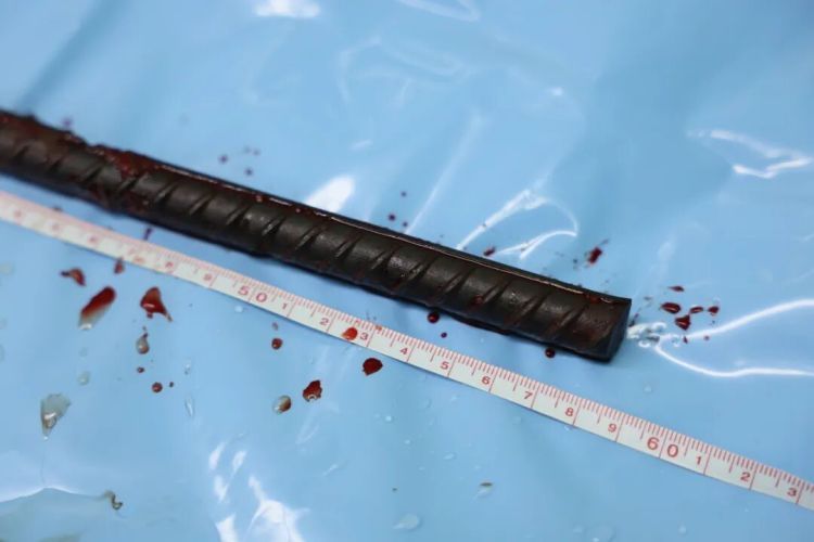 常州一男子不慎坠落,被58厘米钢筋斜插贯穿腰腹!生命危在旦夕…… 常州一男子不慎坠落,被58厘米钢筋斜插贯穿腰腹!生命危在旦夕……