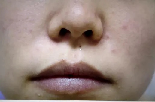 密密麻麻全是活的!浙江女子反复发作:太害怕了;一查更崩溃… 密密麻麻全是活的!浙江女子反复发作:太害怕了;一查更崩溃…