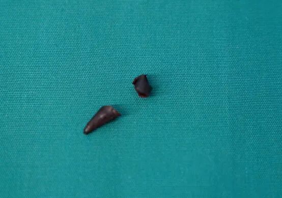 70岁大爷查出肺癌,一刀下去结果是辣椒卡肺里了 70岁大爷查出肺癌,一刀下去结果是辣椒卡肺里了