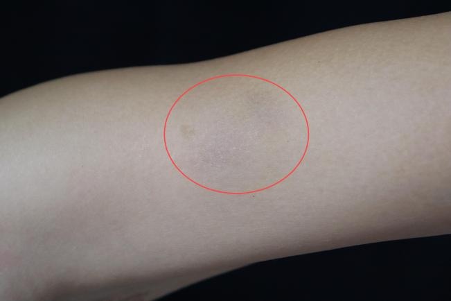 女子手臂取出2条10多厘米活虫!医生:肿块会动就可能是它 女子手臂取出2条10多厘米活虫!医生:肿块会动就可能是它