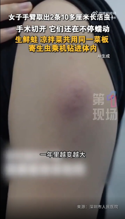 女子手臂长出肿包,医生切开皮肤取出两条10厘米活虫!紧急提醒:做饭时这个习惯要不得 女子手臂长出肿包,医生切开皮肤取出两条10厘米活虫!紧急提醒:做饭时这个习惯要不得
