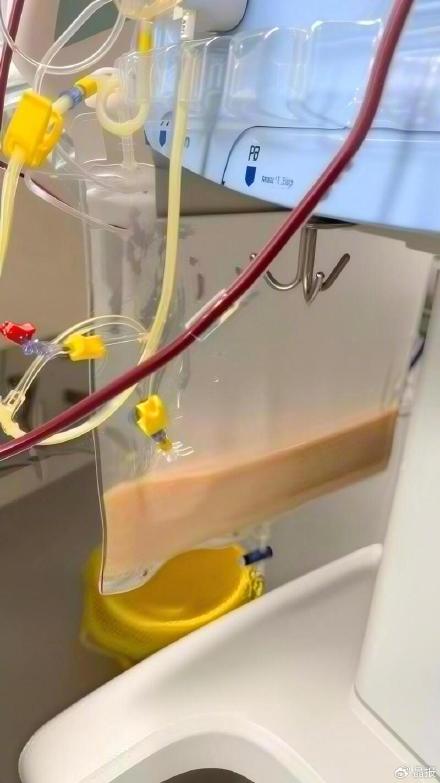 医生回应女子奶茶喝出乳糜血进ICU 医生回应女子奶茶喝出乳糜血进ICU