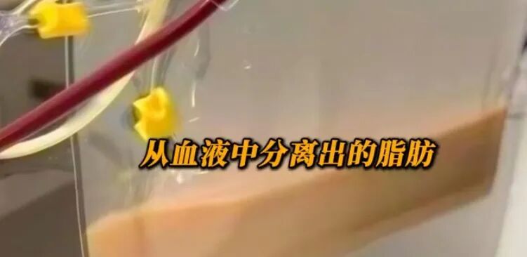血液变“牛奶色”、甘油三酯超标118倍!女子1天3杯奶茶喝进ICU 血液变“牛奶色”、甘油三酯超标118倍!女子1天3杯奶茶喝进ICU