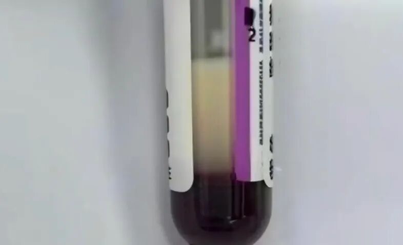 血液变“牛奶色”、甘油三酯超标118倍!女子1天3杯奶茶喝进ICU 血液变“牛奶色”、甘油三酯超标118倍!女子1天3杯奶茶喝进ICU