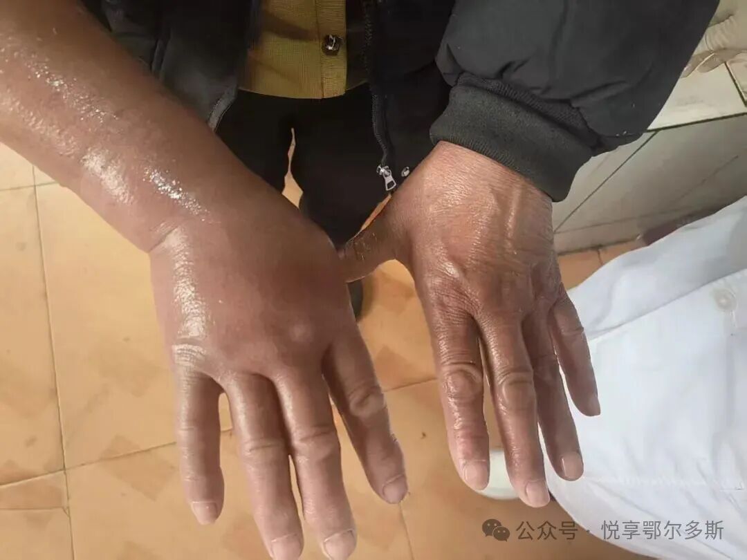 内蒙古一村民被毒蛇咬伤 ! 周边无适配抗蛇毒血清 !当地卫生部门紧急施救→ 内蒙古一村民被毒蛇咬伤 ! 周边无适配抗蛇毒血清 !当地卫生部门紧急施救→