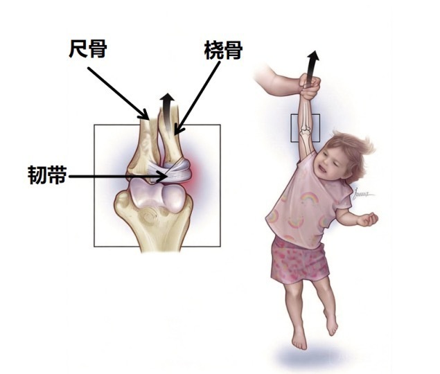 孩子胳膊一拉就 “脱臼”,或是桡骨小头半脱位!专家:这些日常小动作最易拉伤 孩子胳膊一拉就 “脱臼”,或是桡骨小头半脱位!专家:这些日常小动作最易拉伤