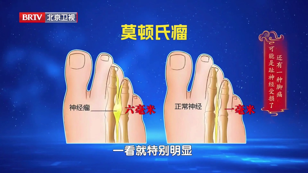 走路多了脚疼不正常?医生:这种疼可能是神经在报警,两个小妙招,轻松护足 走路多了脚疼不正常?医生:这种疼可能是神经在报警,两个小妙招,轻松护足