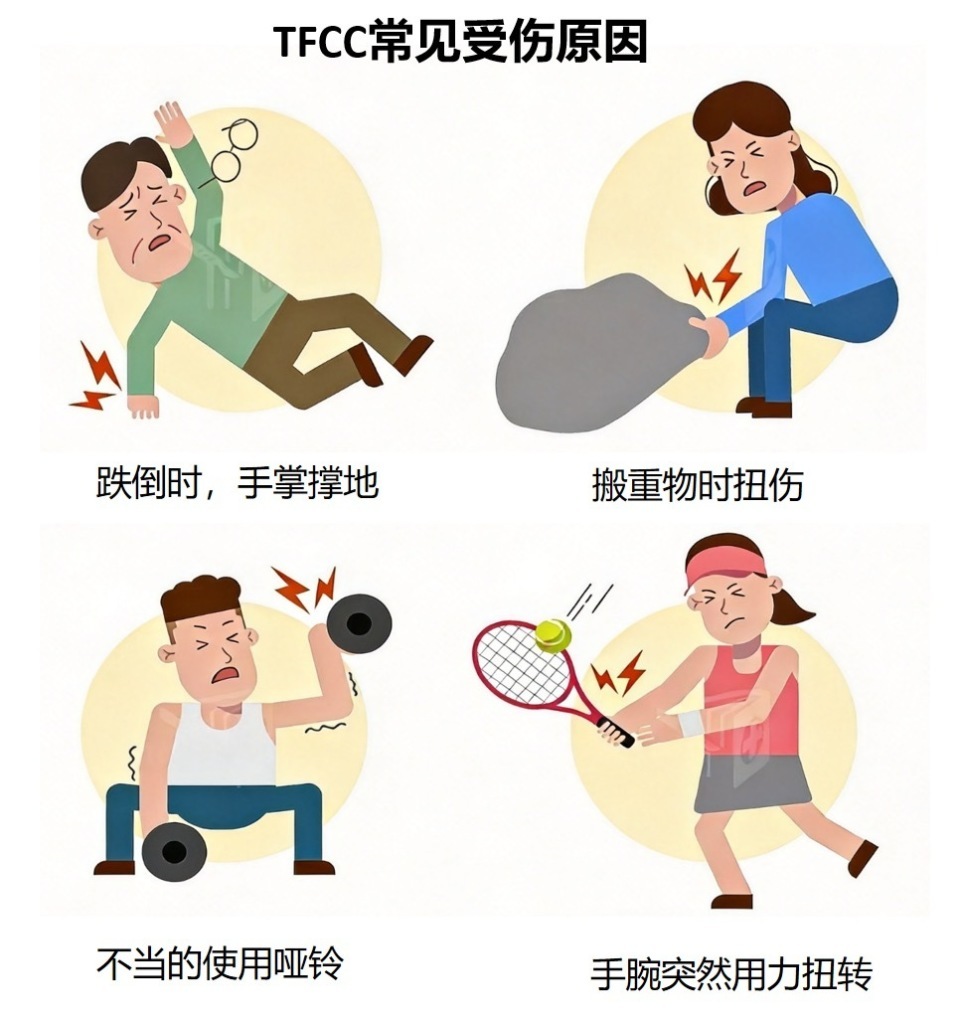 手腕小指一侧隐隐作痛?医生提醒:勿当腱鞘炎,可能是TFCC损伤! 手腕小指一侧隐隐作痛?医生提醒:勿当腱鞘炎,可能是TFCC损伤!