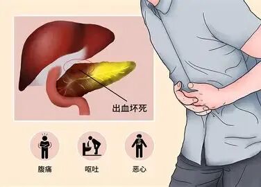 预防胰腺炎 10条忠告 预防胰腺炎 10条忠告
