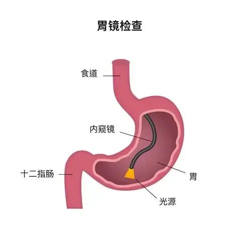 预防胰腺炎 10条忠告 预防胰腺炎 10条忠告